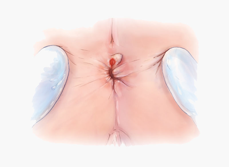 Ραγάδα Πρωκτού